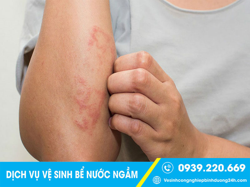 Nước chứa trong bể nước ngầm bẩn là nguyên nhân gây nhiều vấn đề về da liễu, ngứa ngáy khó chịu